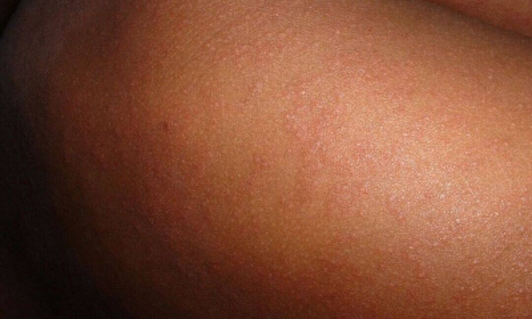 Bangladesh measles outbreak claims 631 children since march