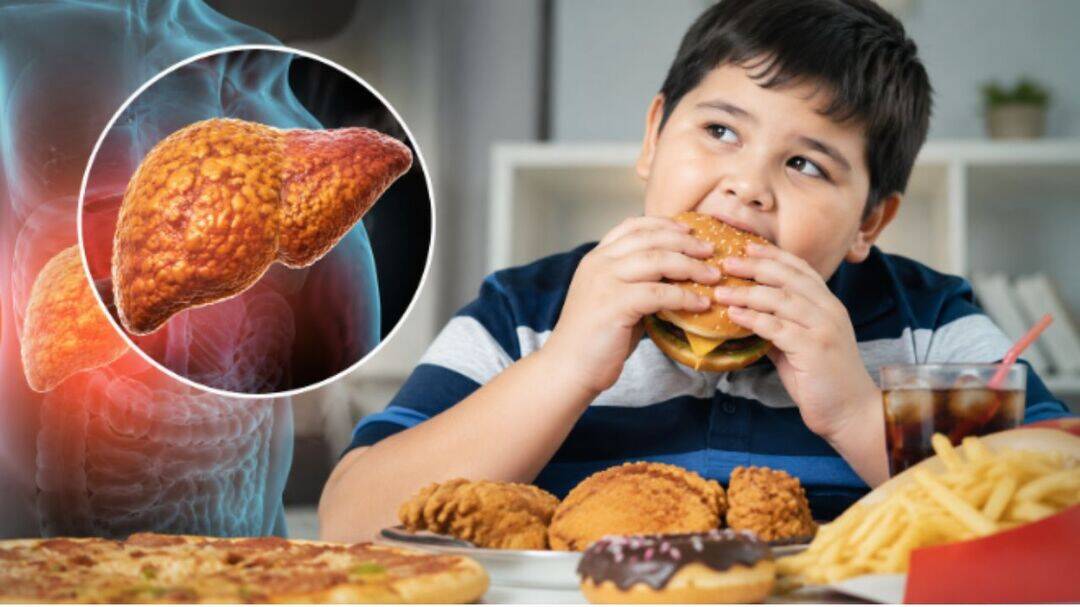 Fatty liver in kids rising fast as junk food intake surges