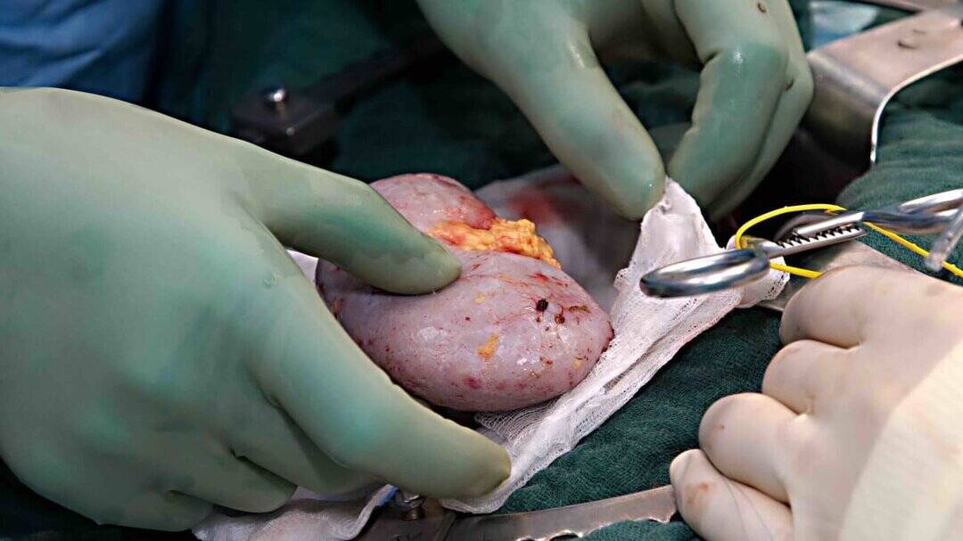 AIIMS study moots research on gender divide among kidney donors