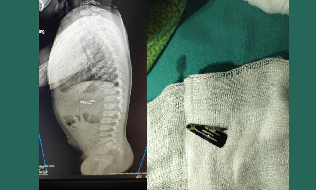 Baby saved after open hairpin gets stuck in intestine