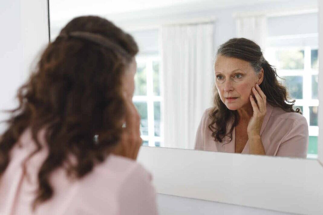 What is the connection between menopause hormones and melasma?