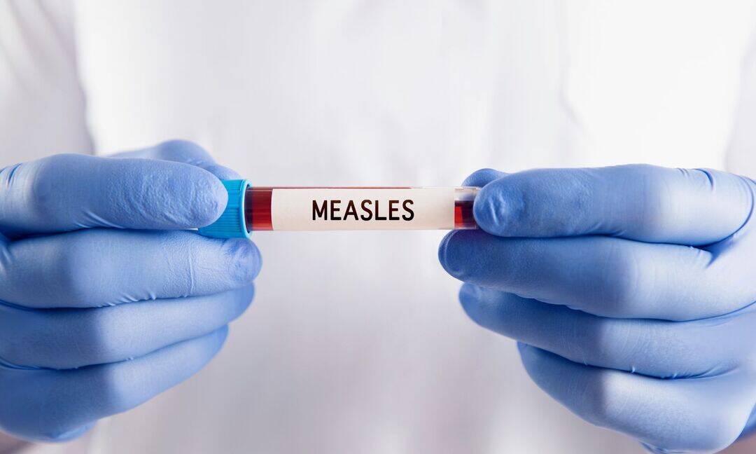 Measles, dengue outbreaks strain Bangladesh’s health system