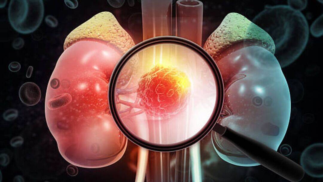 Kidney cancer: Why early detection can save your life 