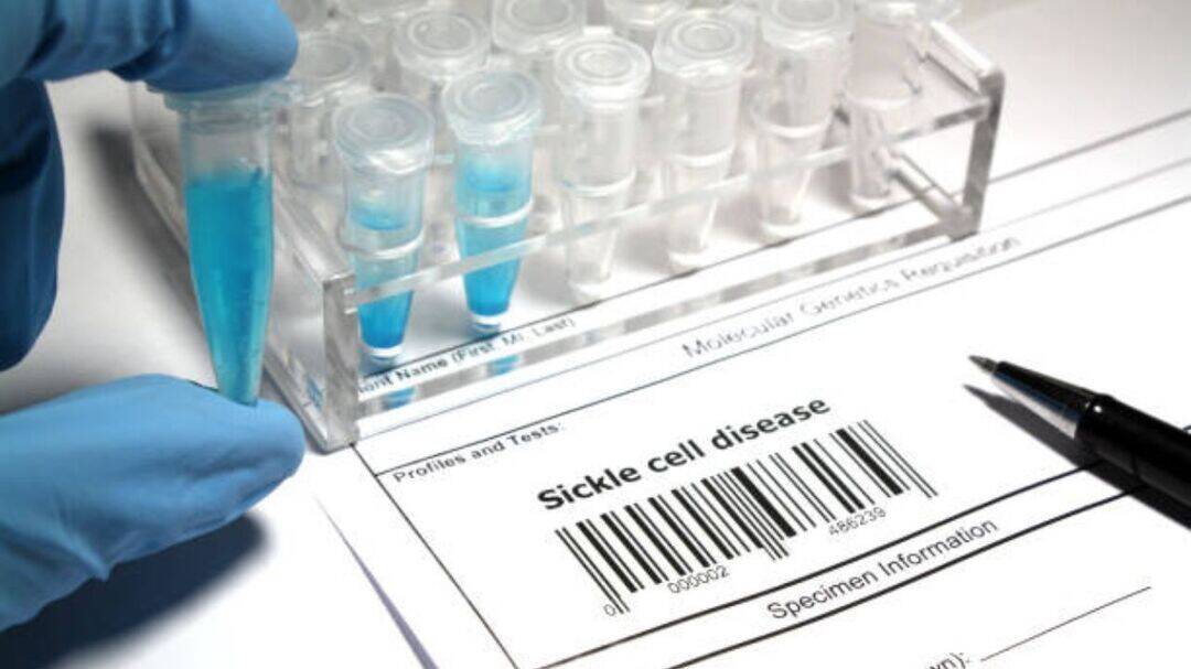 Does sickle cell disease end normal life? 