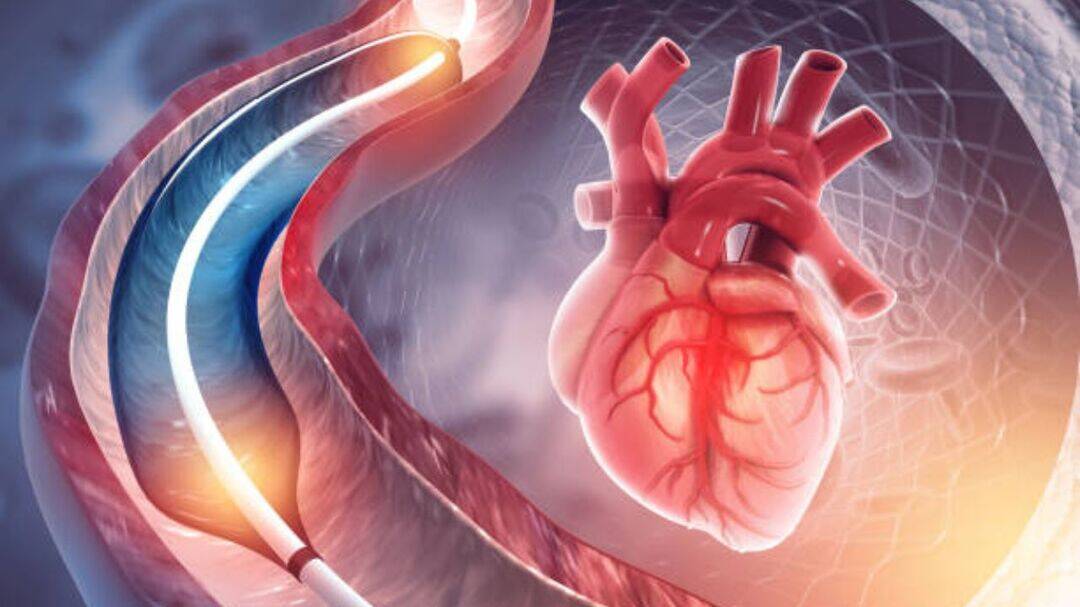 Doctors debunk common myths about angiography