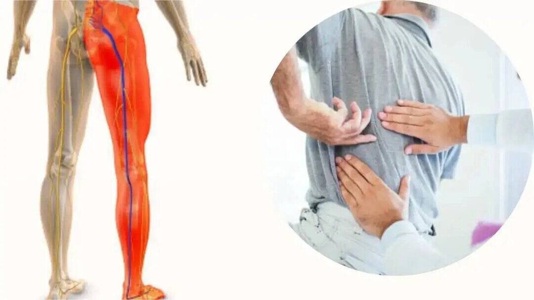 Why shooting leg pain is a serious warning sign of sciatica