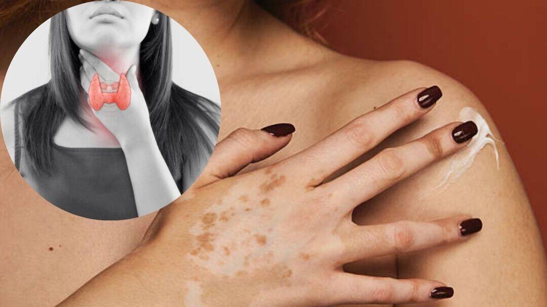 Vitiligo and thyroid disease: The hidden autoimmune link
