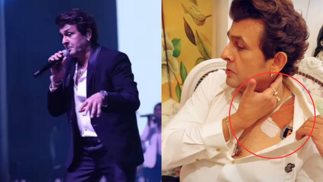 Sonu Nigam continues performing despite worsening nerve injury