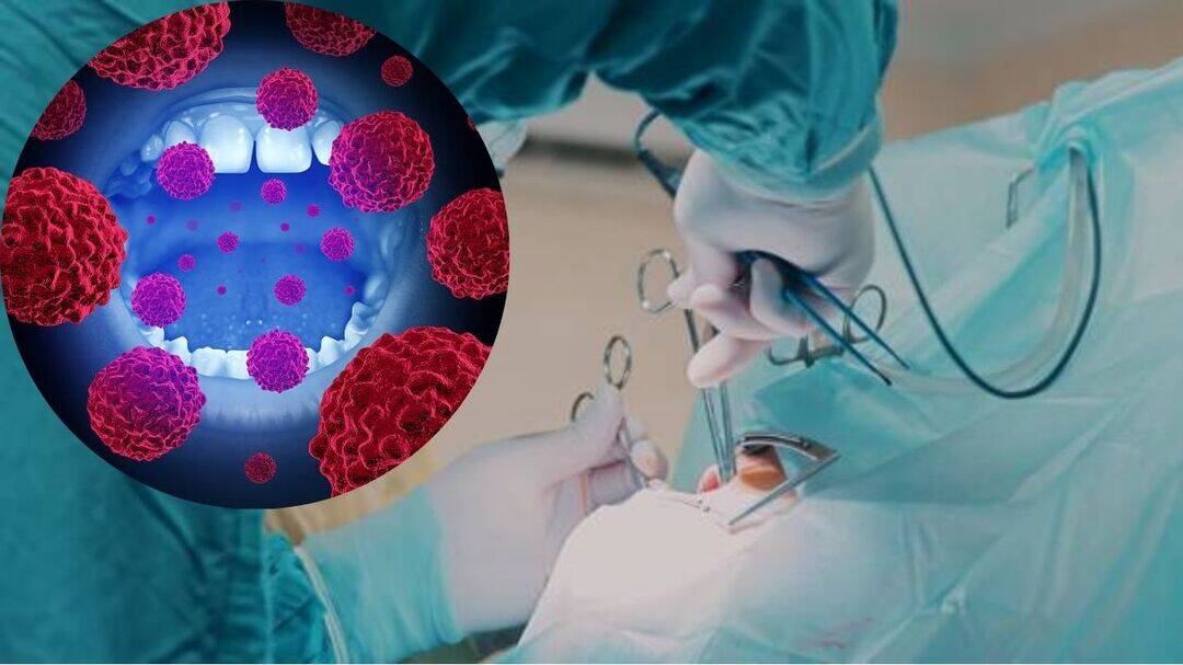 73-year-old beats stage 3 oral cancer after rare surgery