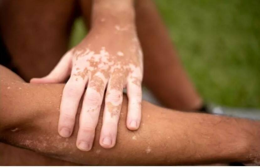 Is vitiligo contagious or just a myth?