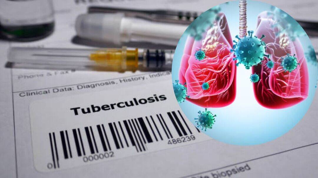 Nasal TB vaccine boosts antibiotics for drug-resistant TB: Study