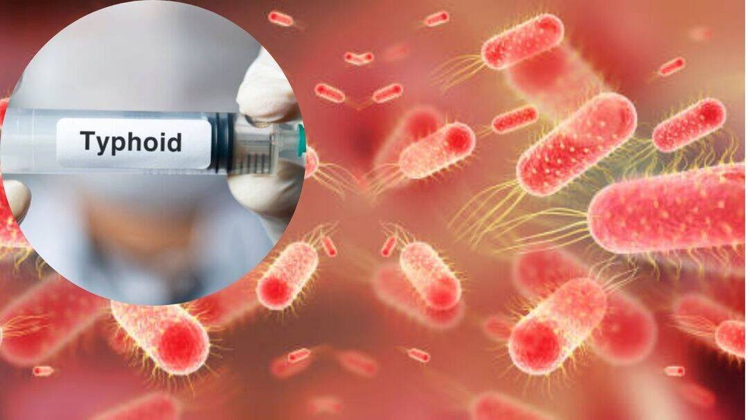 India sees typhoid surge amid floodwater contamination concerns