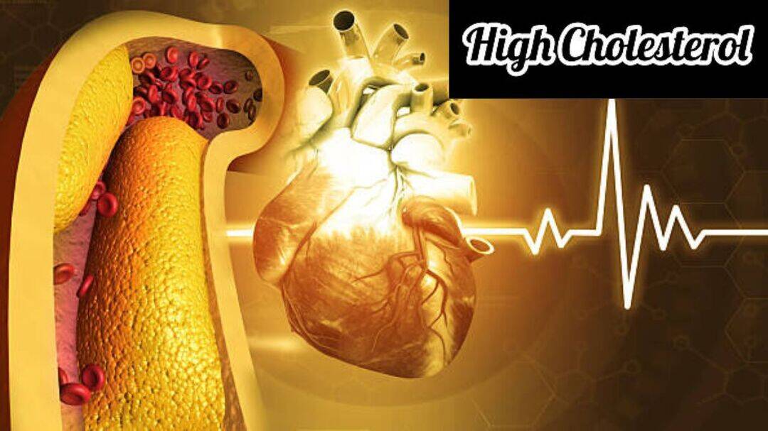 New guidelines highlight need for earlier cholesterol control