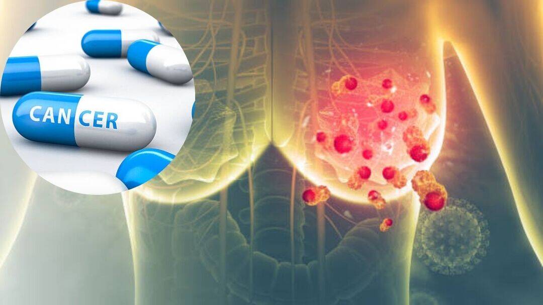 Ribociclib case: How judicial delays impact breast cancer care