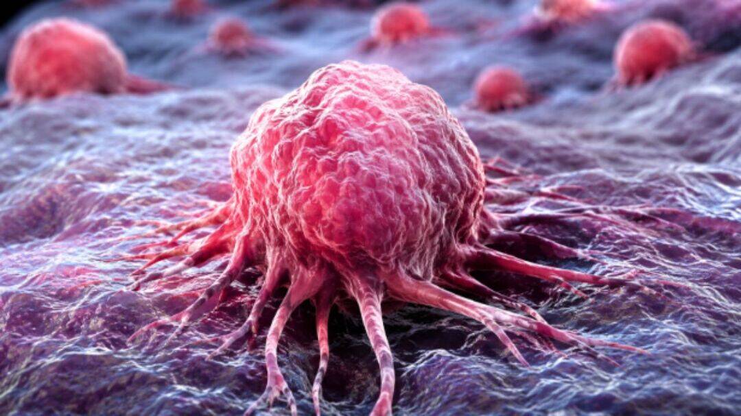 Persistent lump could signal rare cancer: Experts
