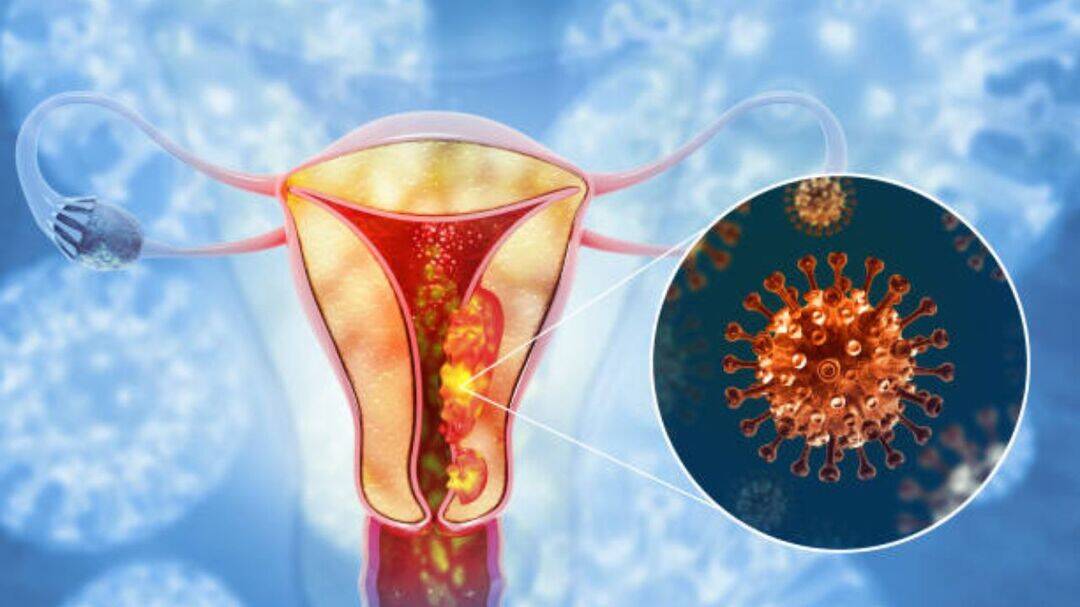 New tests may detect endometriosis without surgery