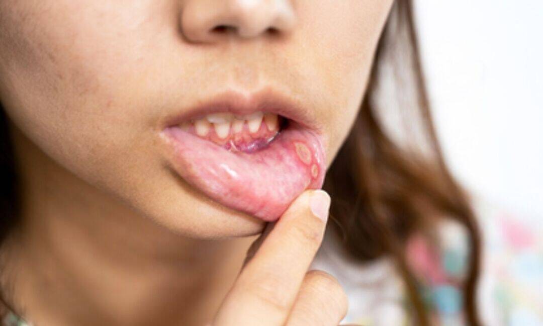Simple home remedies may help relieve mouth ulcers