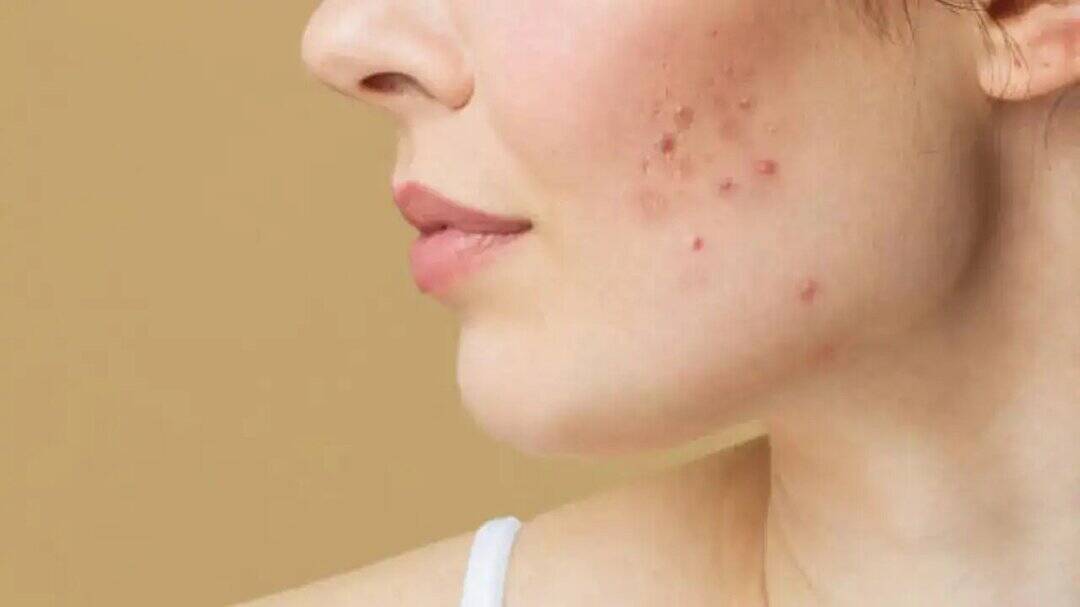 Why PCOS and insulin resistance cause adult acne?
