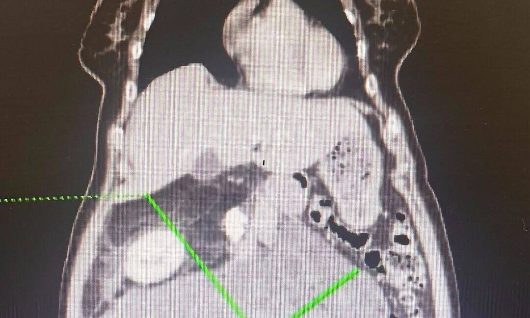 Mumbai woman's 'Gas' symptoms reveal 30-cm tumour