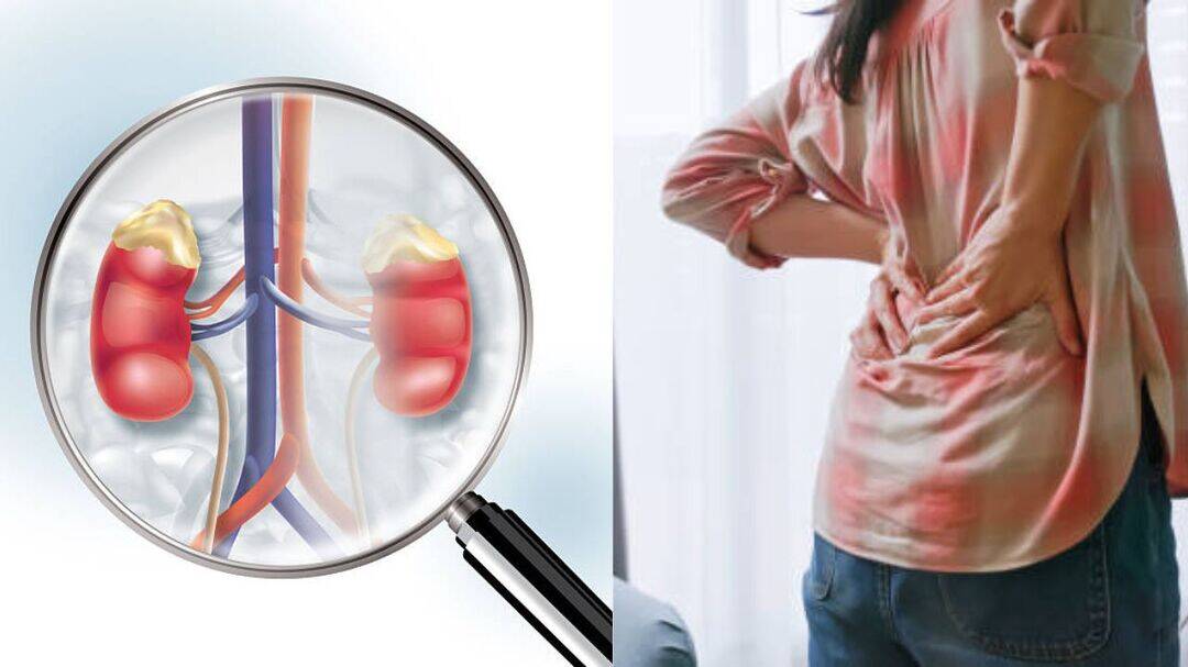 Finerenone slows kidney disease even without diabetes: Study