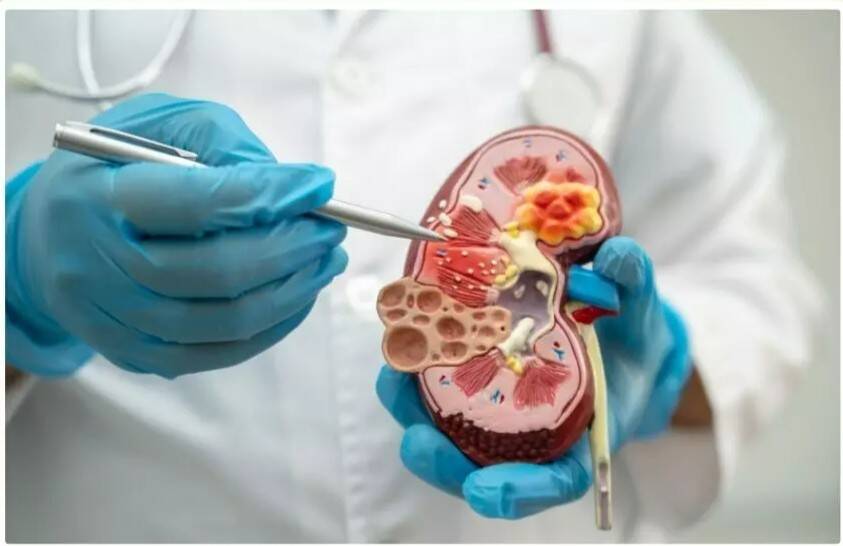 Can drinking less water in monsoon cause kidney stones?