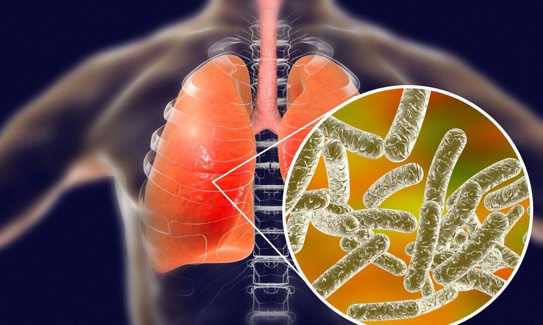 New York reports 3rd death from Legionnaires’ disease