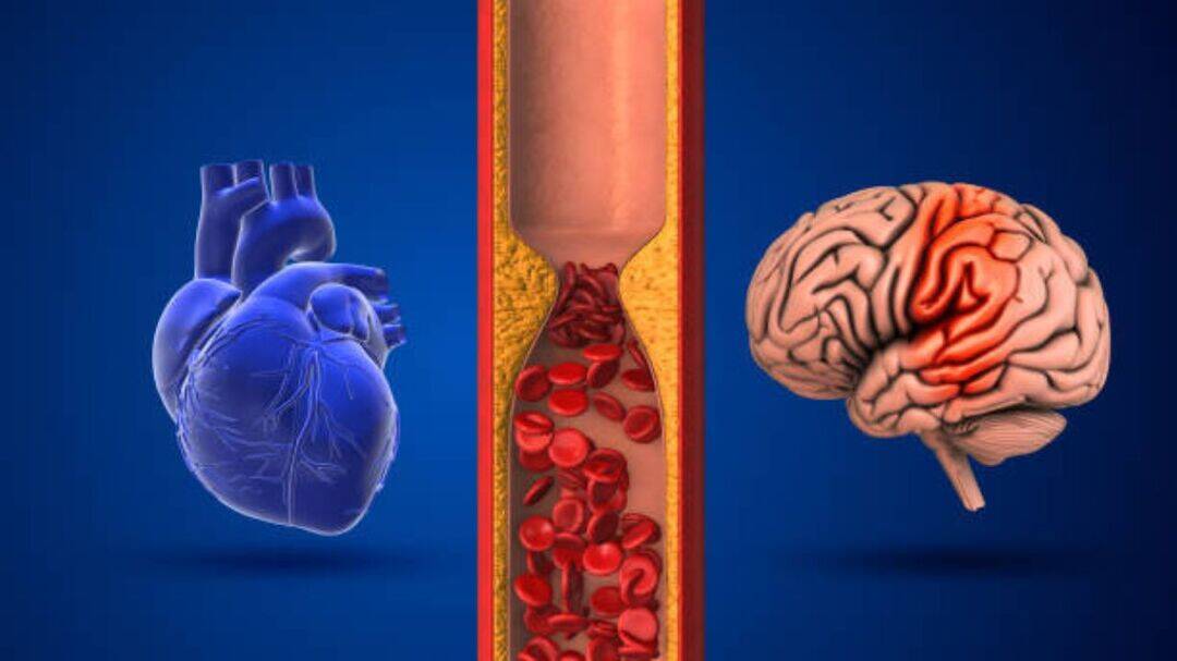 World Brain Day: Silent condition that raises stroke risk 