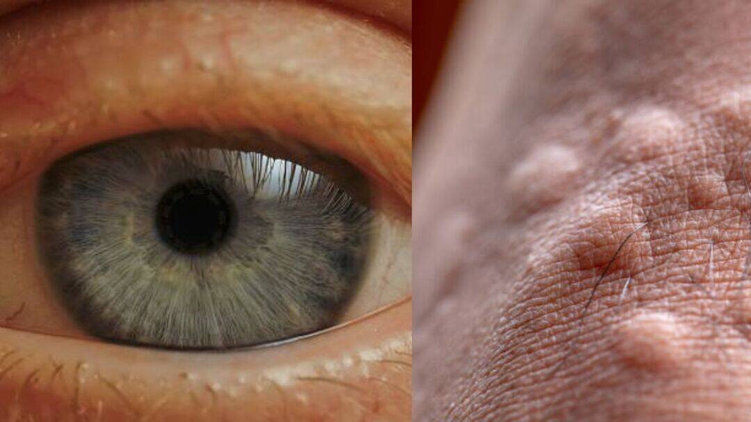 Warning signs of high cholesterol on eyes, skin, and legs