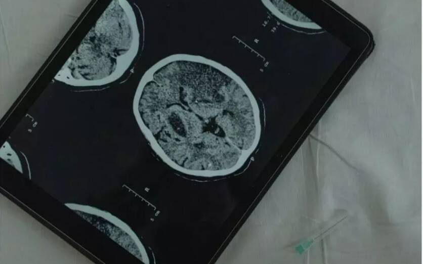 Is your headache a migraine or a brain tumour?