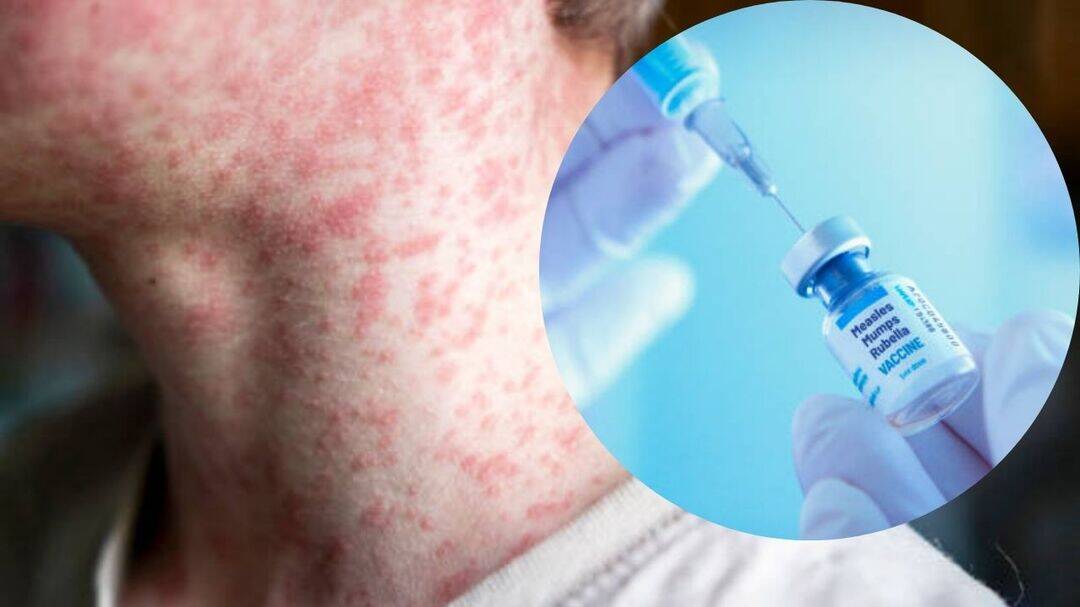 US measles outbreak hits 35-year high as cases cross 2,300