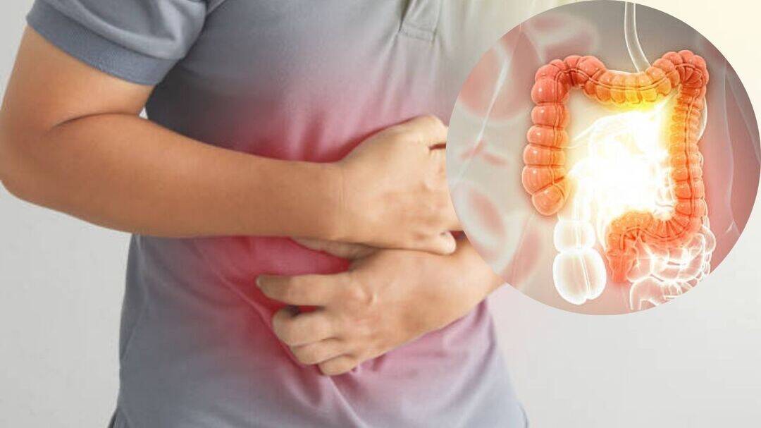 Why summer stomach upset could signal ulcerative colitis?