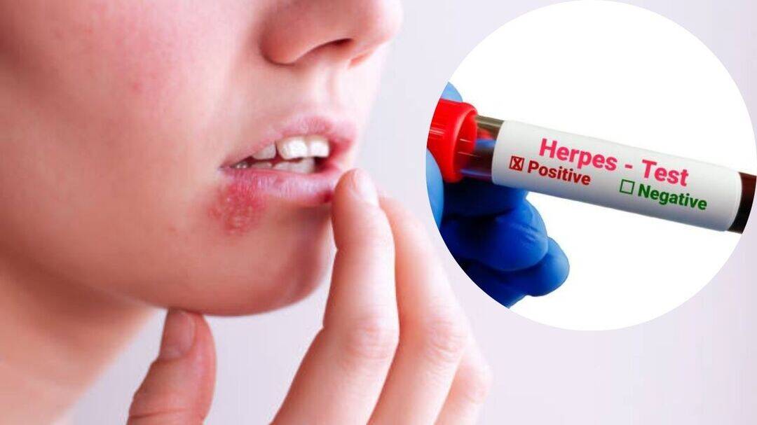 Billions live with herpes, most without knowing: WHO 