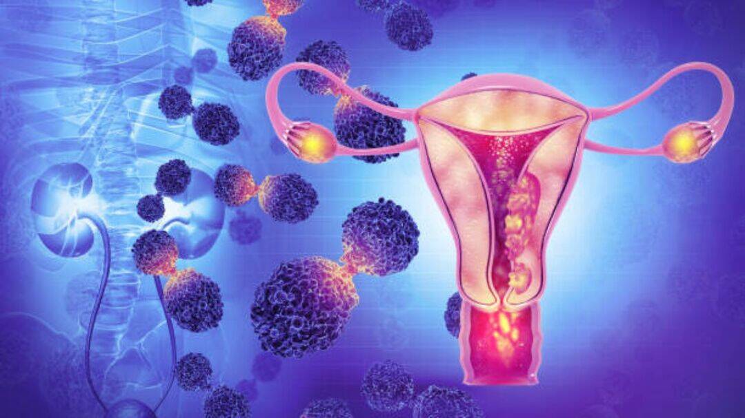 World's first patient receives landmark ovarian cancer treatment