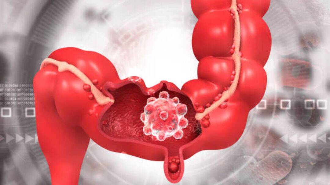 Colorectal cancer rises to India's 4th most common cancer: Report