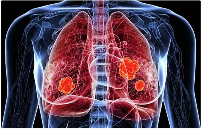 Lung cancer is not limited to people who smoke