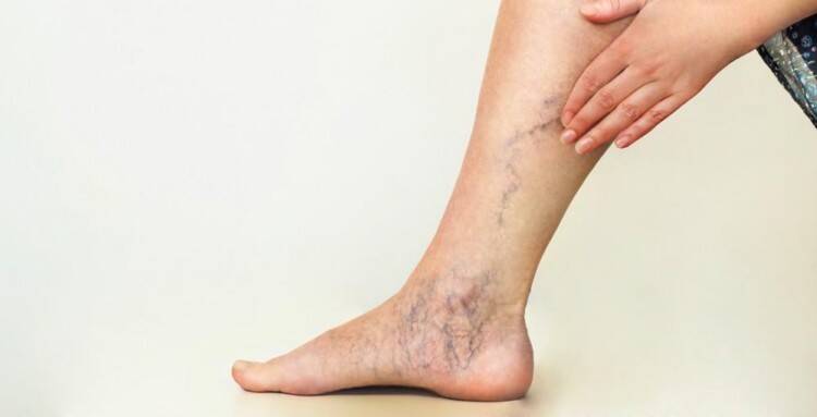 Varicose veins recognised as chronic condition, not cosmetic issue