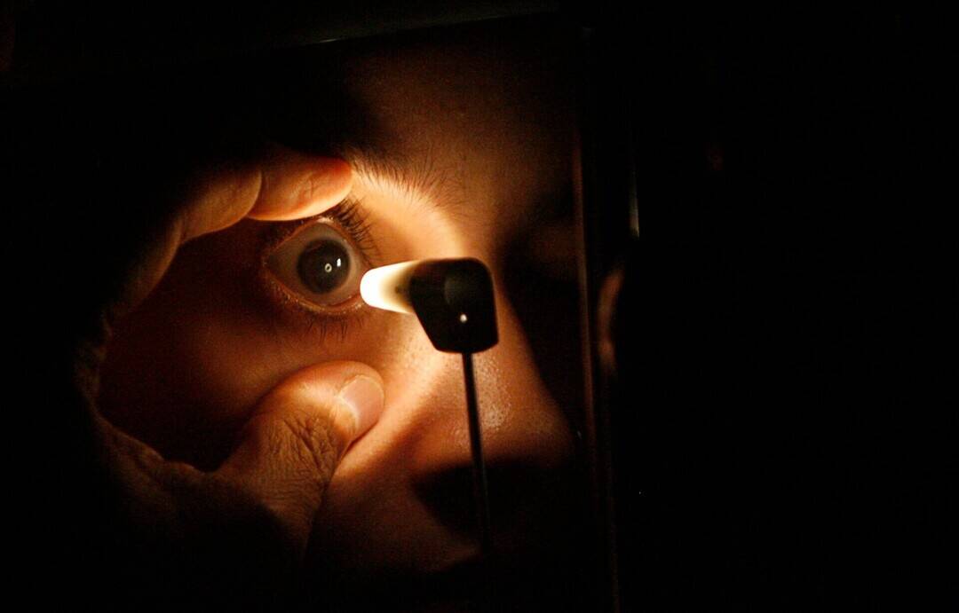What is the 'dancing eyes' condition?