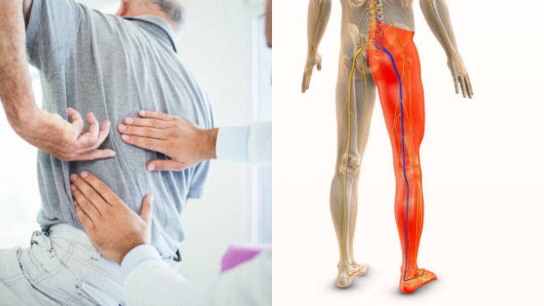 Expert explains symptoms of sciatica that should not be ignored