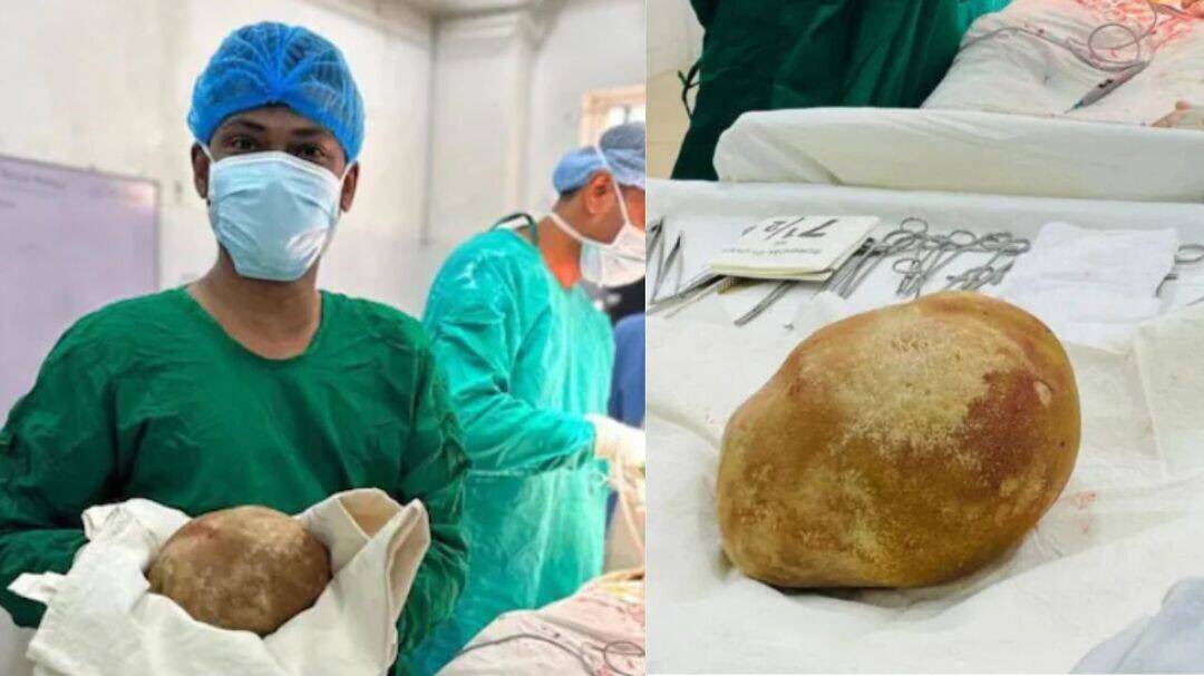 3.1-kg bladder stone removed, could be the largest ever