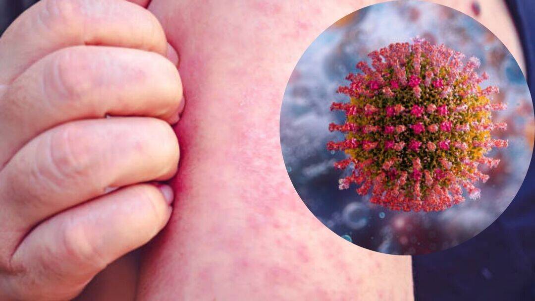 Measles makes a dangerous comeback: Why millions are at risk