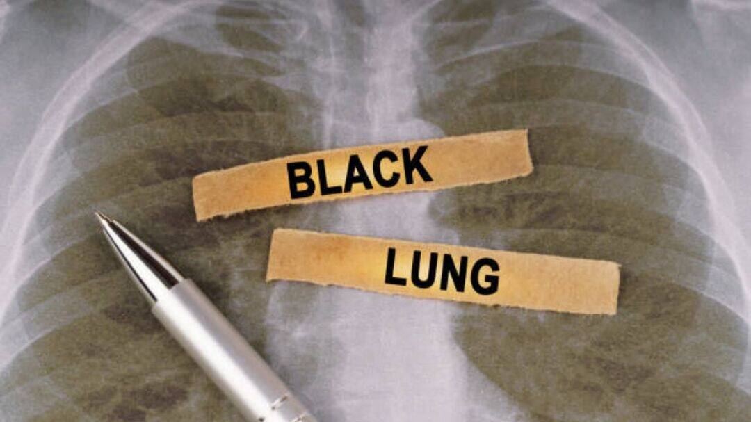 Black lung disease surging across West Virginia in the US