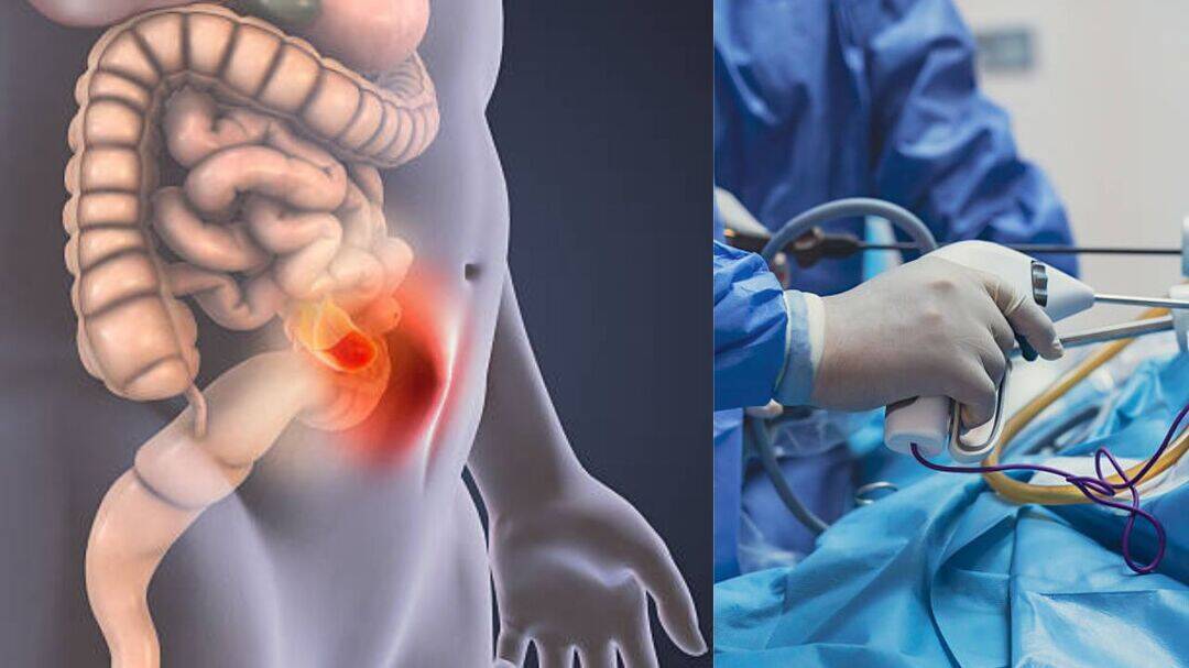 Robotic hernia surgery: How technology is changing repairs