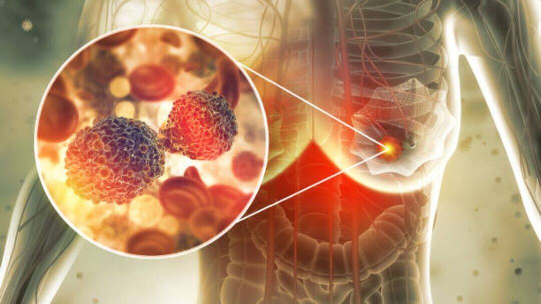 FDA approves new daily pill for certain advanced breast cancers