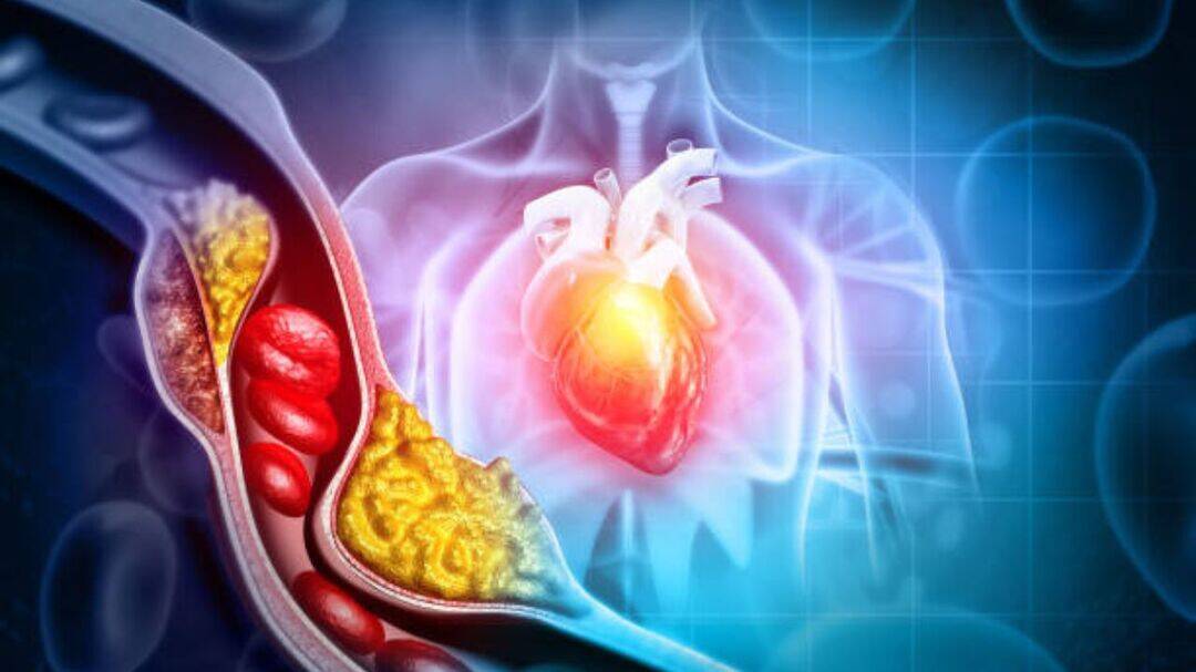 Artery plaque isn't just cholesterol: What you need to know