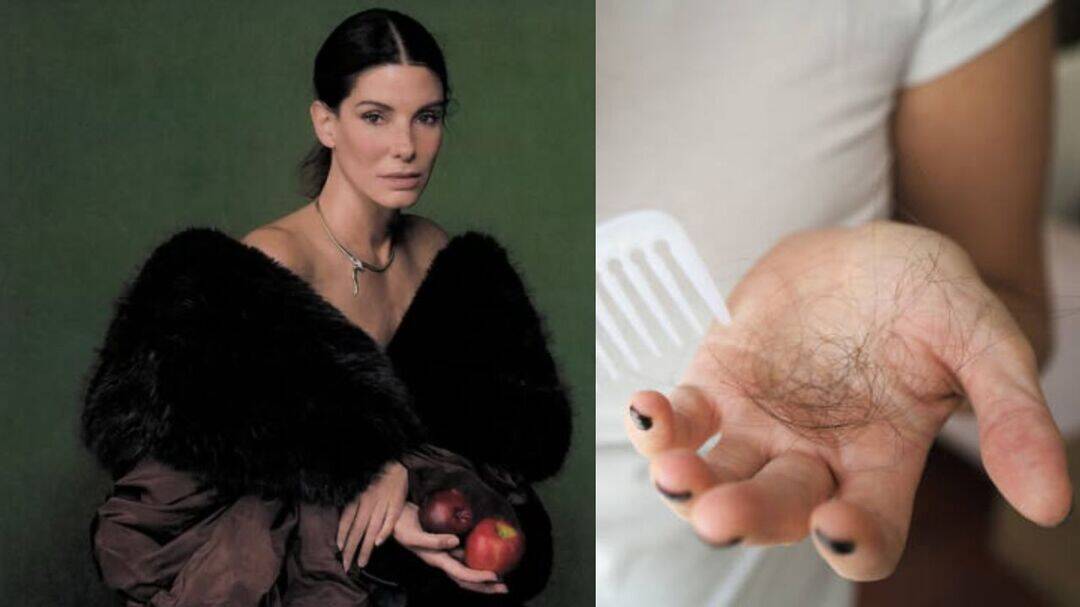 Sandra Bullock’s experience highlights stress-induced hair loss