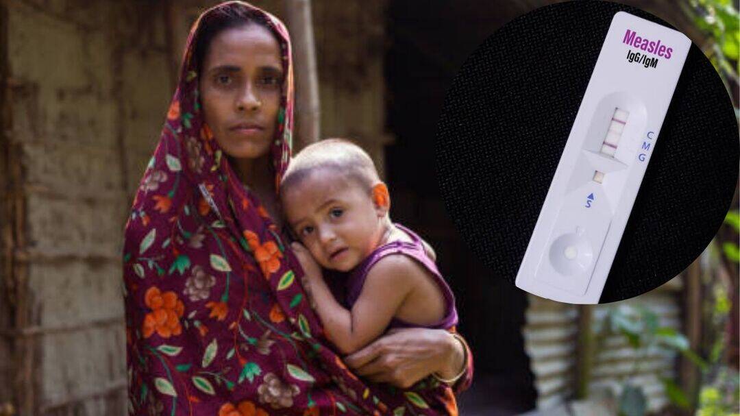 Bangladesh measles deaths cross 1,000 amid ongoing outbreak