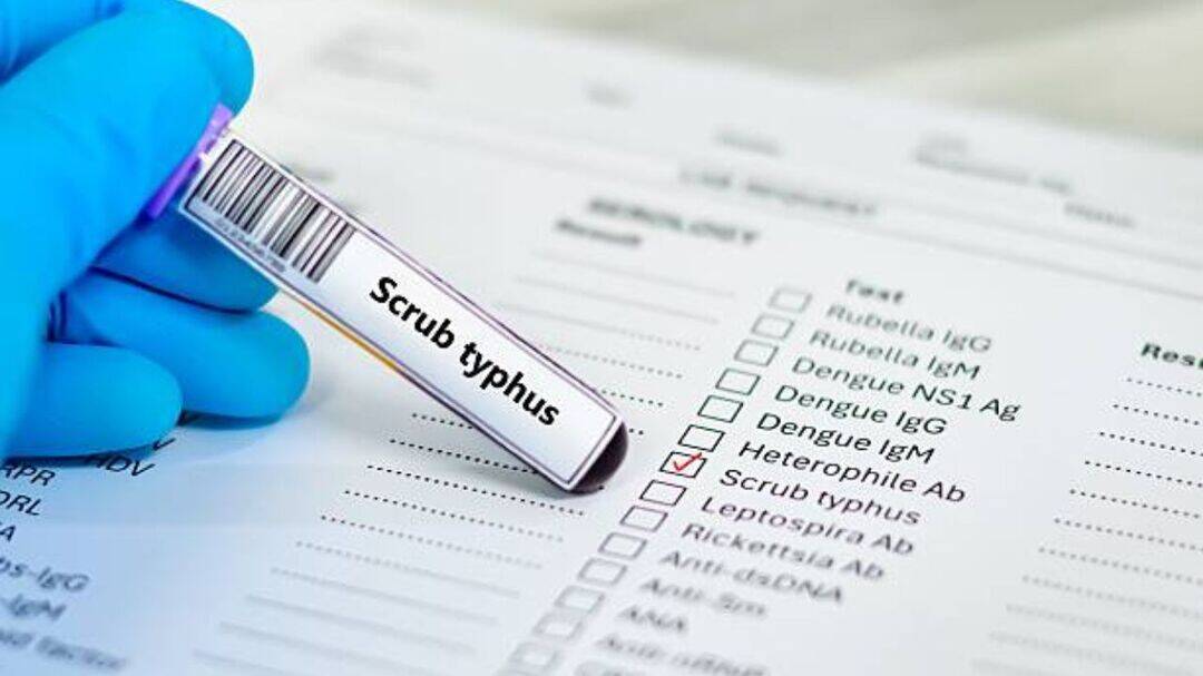 What is scrub typhus, bacterial infection spreading in Ghaziabad?