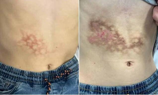Boy develops toasted skin syndrome after resting laptop on his lap