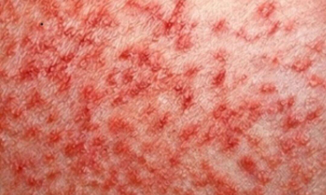 KGMU study finds drug resistant TB in skin TB patients