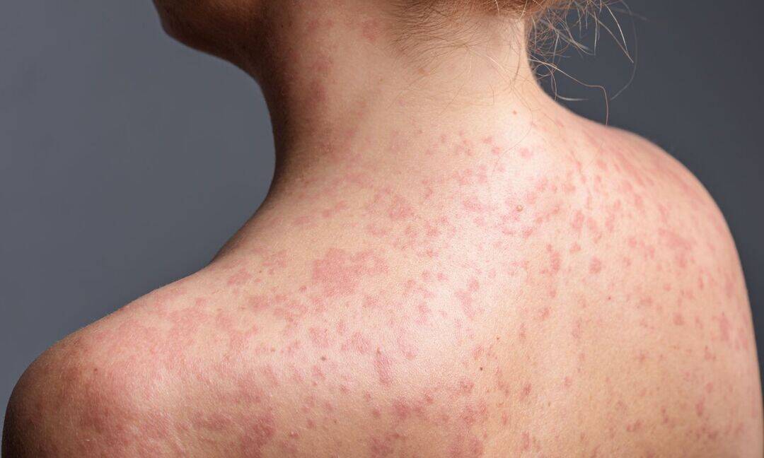 Bangladesh measles outbreak claims over 1,000 lives